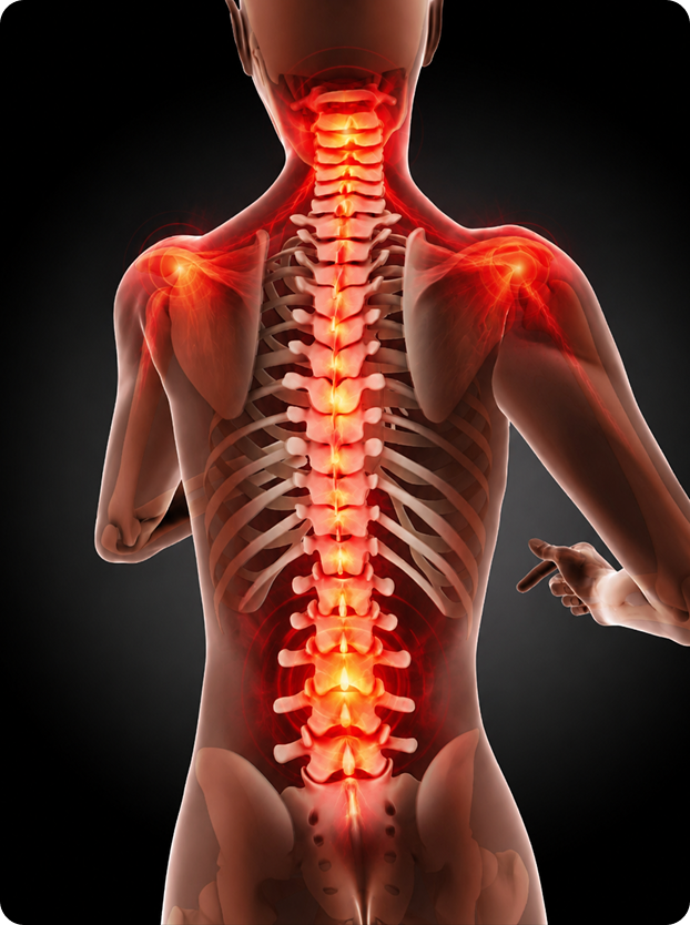 Illustration of the human spine and shoulders with areas of pain highlighted