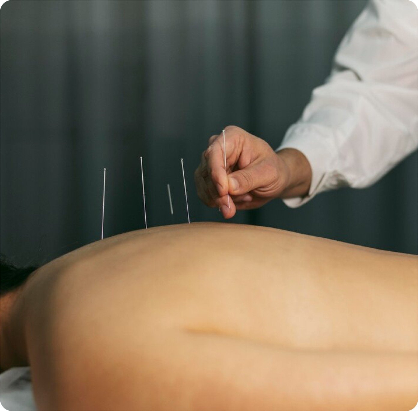Practitioner placing fine acupuncture needles in a patient's back